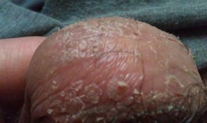 阴囊炎好了，终于不痒了