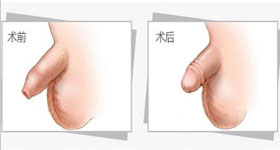 男性包皮过长真的会遗传下一代吗?